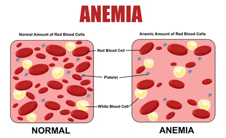 Anemia.jpg
